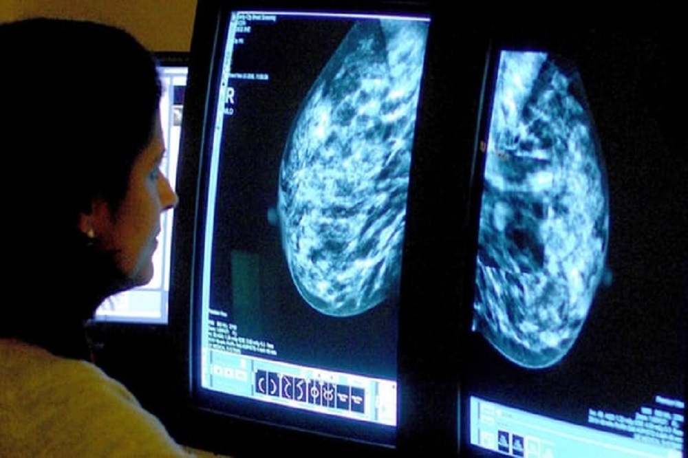 一項最新研究發現，乳癌初期患者在精密醫學治療取向下，可以免於化療。（翻攝自《衛報》）



