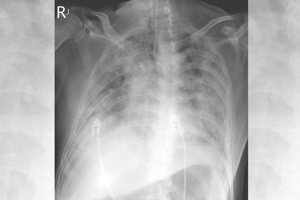 胸腔科醫師蘇一峰表示，一名台商確診卻未第一時間就醫，結果一照X光發現已經是嚴重肺炎的「大白肺」。（取自蘇一峰臉書）
