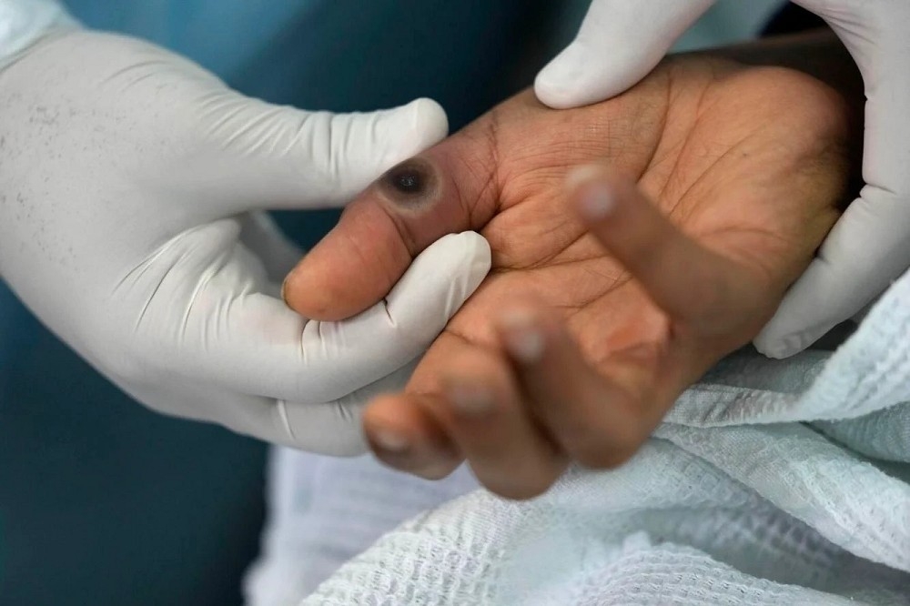 中國猴痘疫情升溫，出現女性確診病例。圖為秘魯猴痘患者的手部徵狀。（美聯社）