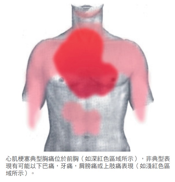 華航董座心肌梗塞猝逝　醫曝6高危族群、這些部位疼痛要小心